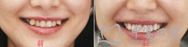 上海虎牙矫正哪里好